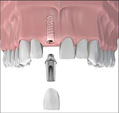 Dental Implants by Dr Tim Hart in Chatswood and North Sydney Suburbs